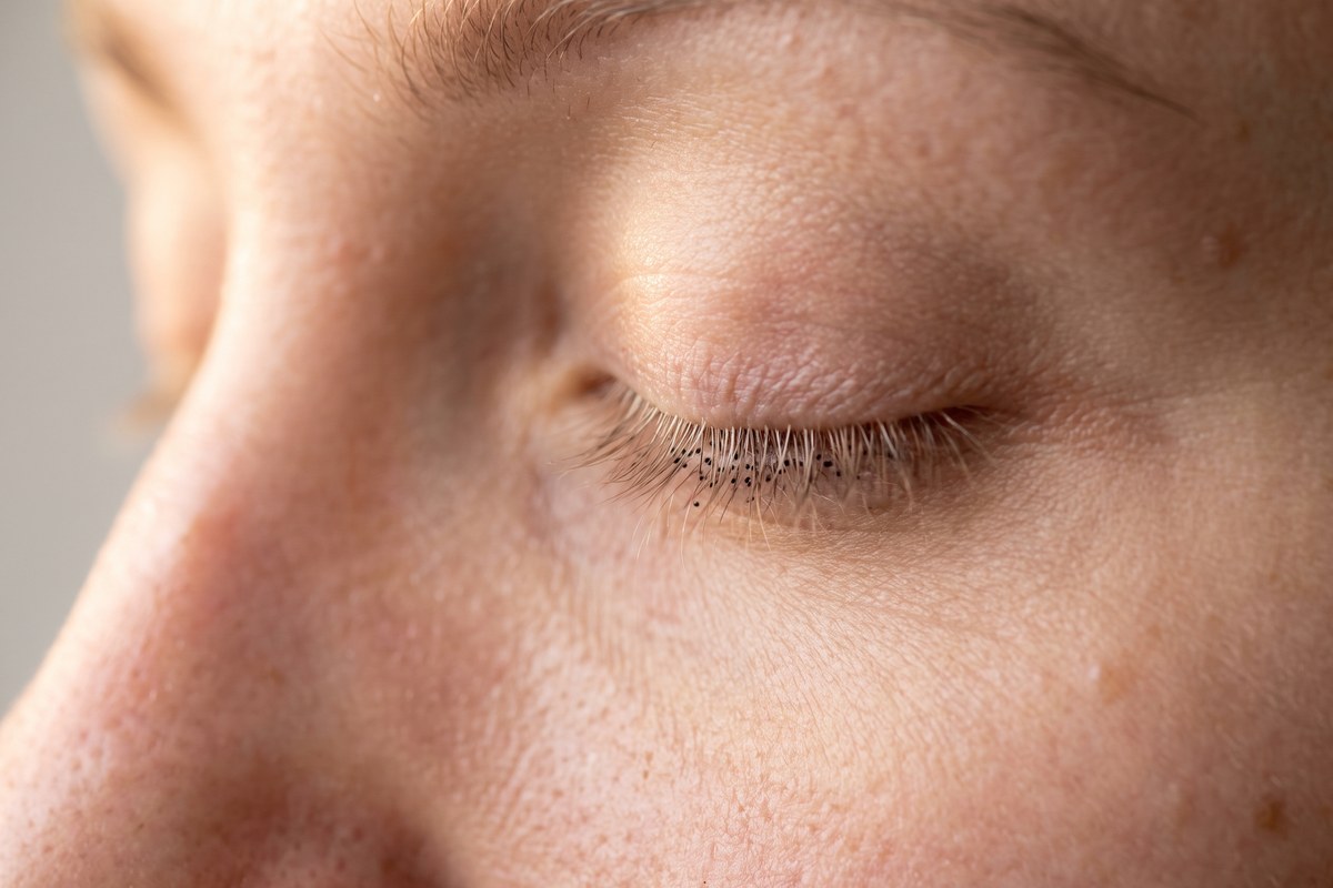 Wimpernkranzverdichtung: winzige Punkte zwischen den Wimpernansätzen