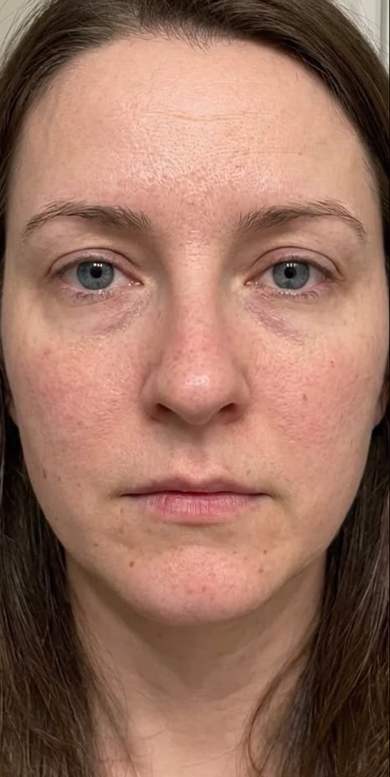 Vorher-Ansicht: Gesicht vor der Anti-Aging-Behandlung